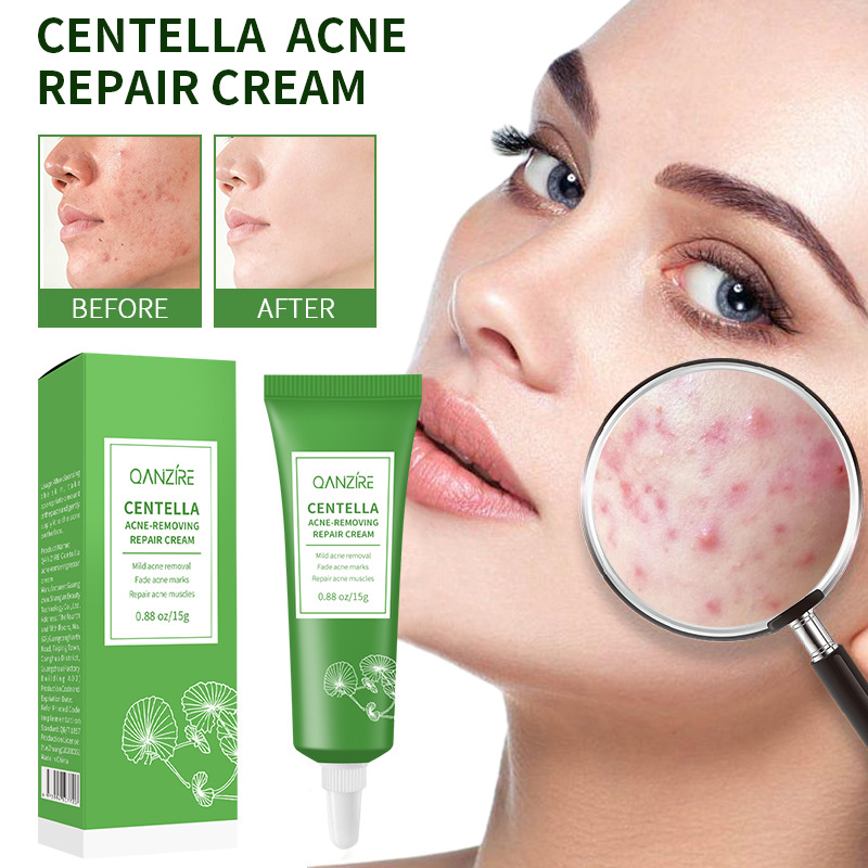 Cross-border full English Centella acne cream Acne cream desalination acne moisturizing cream for foreign trade
